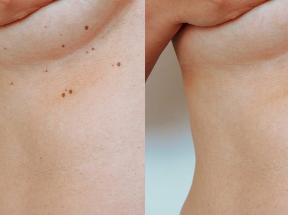 Retouched image imperfect skin.  Skin tags under female breasts.